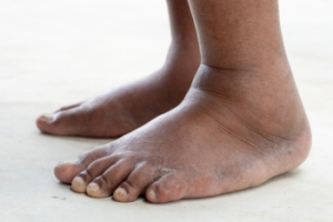 Causes of Swollen Feet