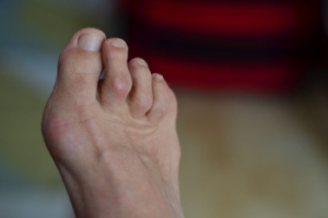 What Is Hammertoe?