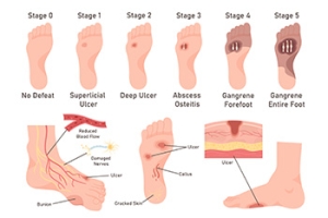 Causes and Symptoms of Foot Ulcers