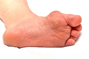 How Podiatrists Treat Foot Corns