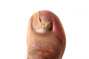 Treatment of Toenail Fungus