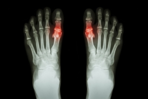 Recognizing Gout Symptoms and Warning Signs