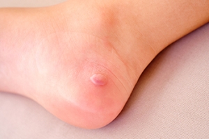 Children&#039;s Foot Blisters and Prevention Tips