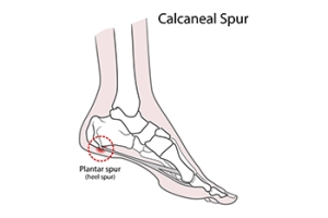 Two Places Where Heel Spurs Can Form