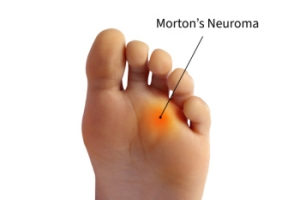 What Is Morton’s Neuroma?