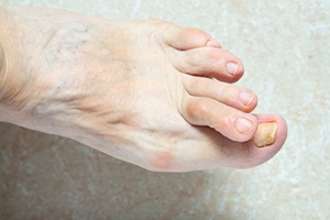 Hammertoe Is a Common Foot Deformity