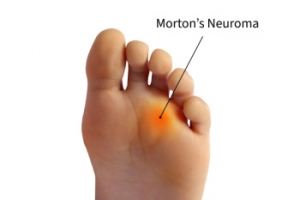 Essential Insights Into Morton&#039;s Neuroma