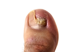 Common Signs of Toenail Fungus