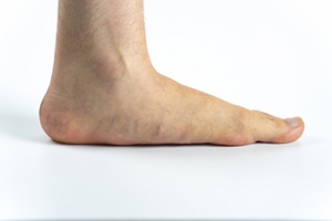 Living With Flat Feet