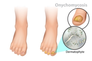 The Progression of Toenail Fungus